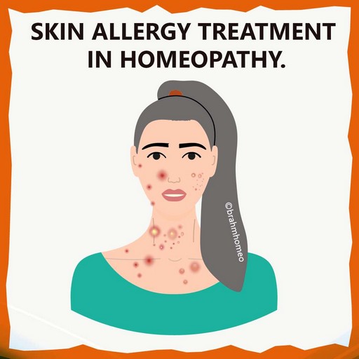 Skin Allergy | Skin Allergy Treatment | Skin Allergy Treatment In ...