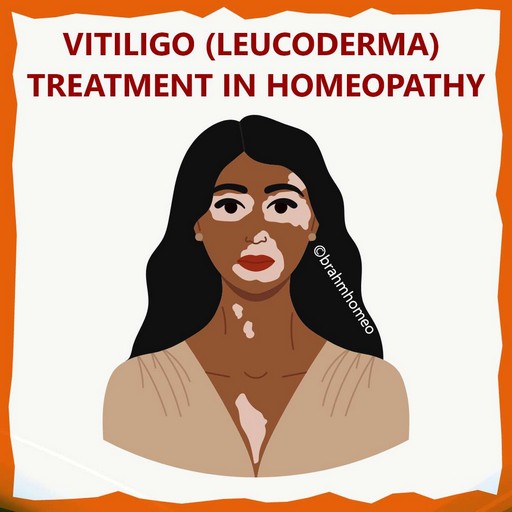 vitiligo-(leucoderma)-treatment-in-homeopathy