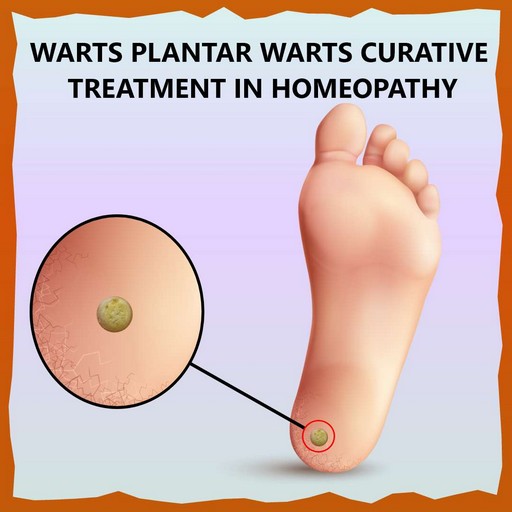 warts-curative-treatment-in-homeopathy