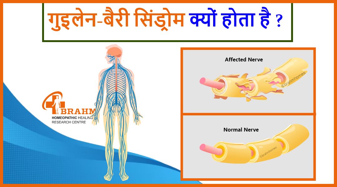 गुइलेन-बैरी सिंड्रोम | गुइलेन बैरी सिंड्रोम क्यों होता है | गुलेन बैरे  सिंड्रोम के लक्षण और उपचार