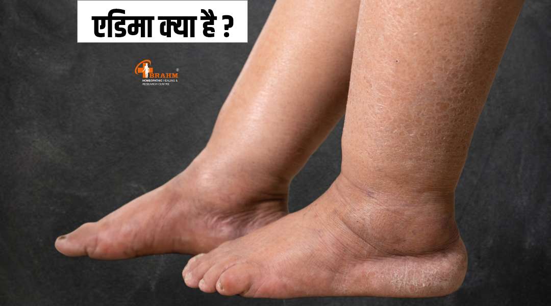 edema ka homeopathy me ilaaj 