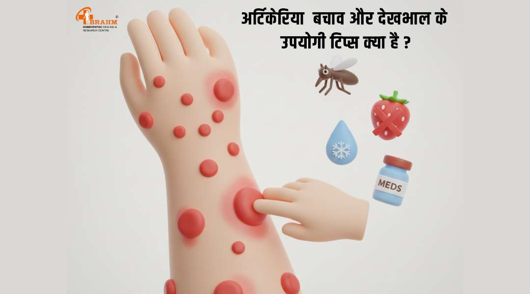 urticaria ka homeopathy me kya ilaaj hai | urticaria ka ilaj in hindi