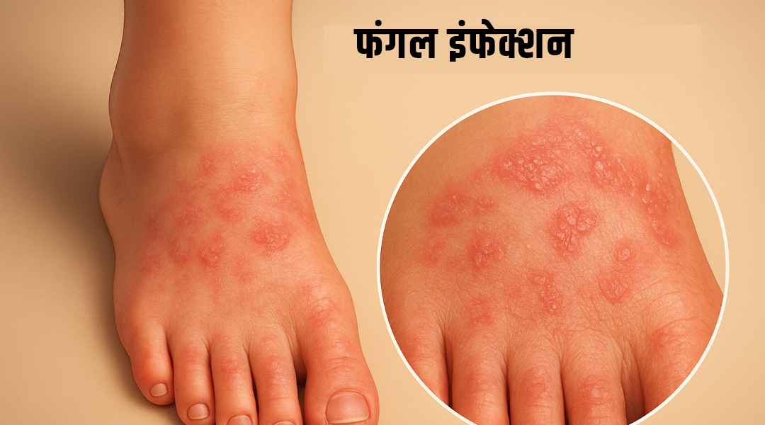 fungal infection treatment in homeopathic