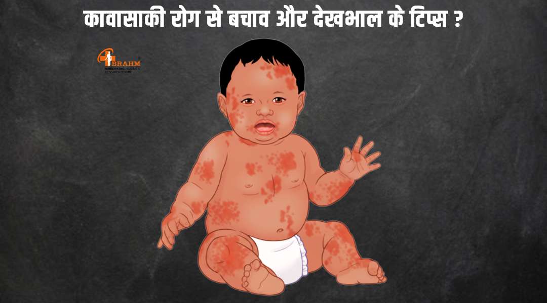 kawasaki rog se bachne ke liye kya tip hai
