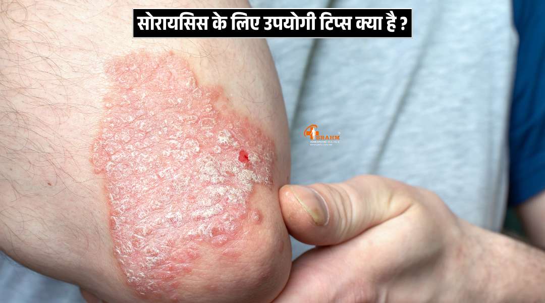  Psoriasis ke liye kya tips ko follow kre?