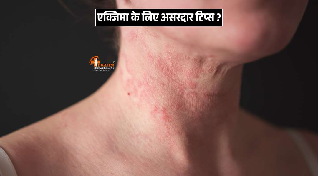 Eczema hone par kya tips ko follow kre?