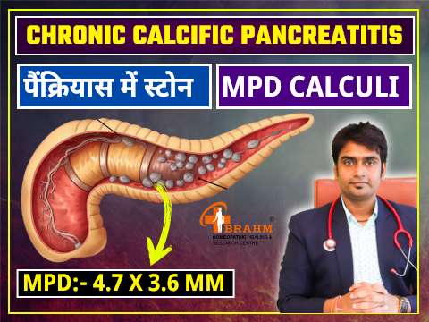 chronic calcific pancreatitis treatment in homeopathy