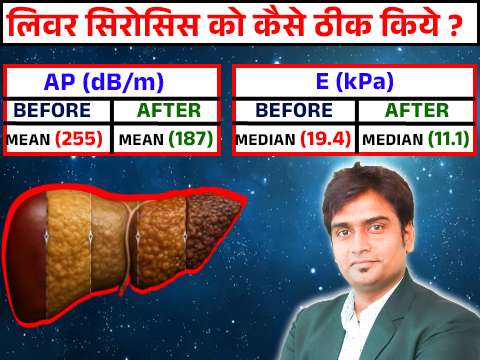 liver cirrhosis ka ilaaj kya hai?