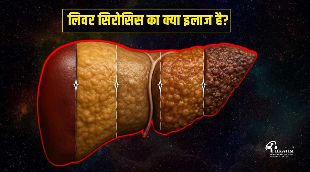 liver cirrhosis ka homeopathic me ilaaj