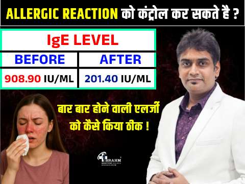 homeopathy me  IgE ka ilaj or ige kya hota hai 