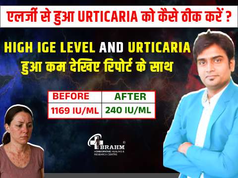 Urticaria ka homeopathy me ilaaj | urticaria kyu hota hai