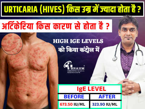 Homeopathic treatment for urticaria 
