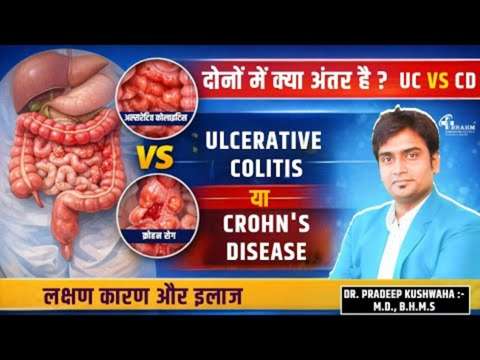 Ulcerative Colitis ka kya upchar hai?
