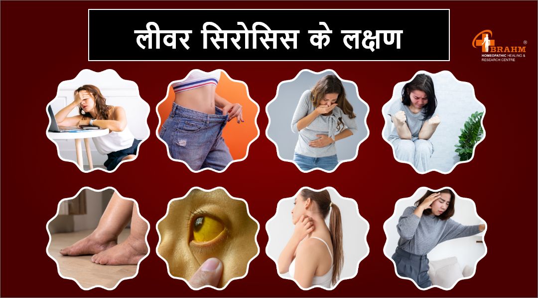 लीवर-सिरोसिस-के-लक्षण