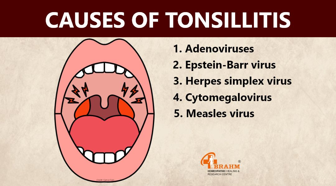 cause-of-Tonsillitis