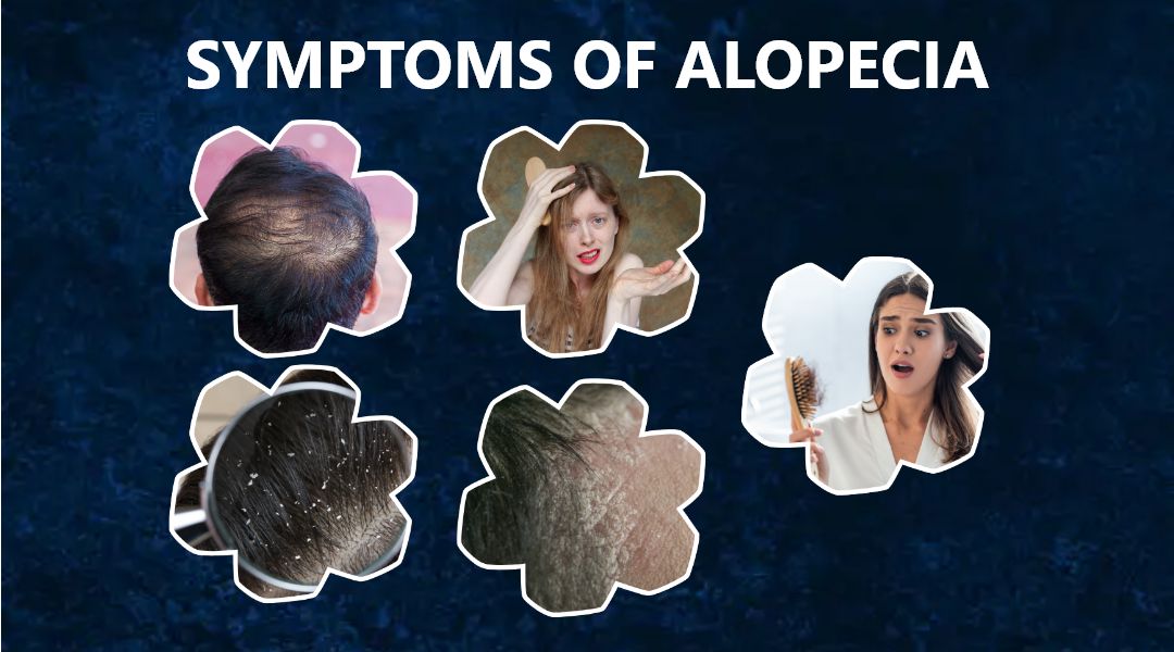 sypmtoms-of-alopecia