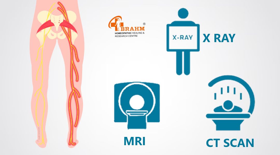 Diagnosis-of-Sciatica.jpg