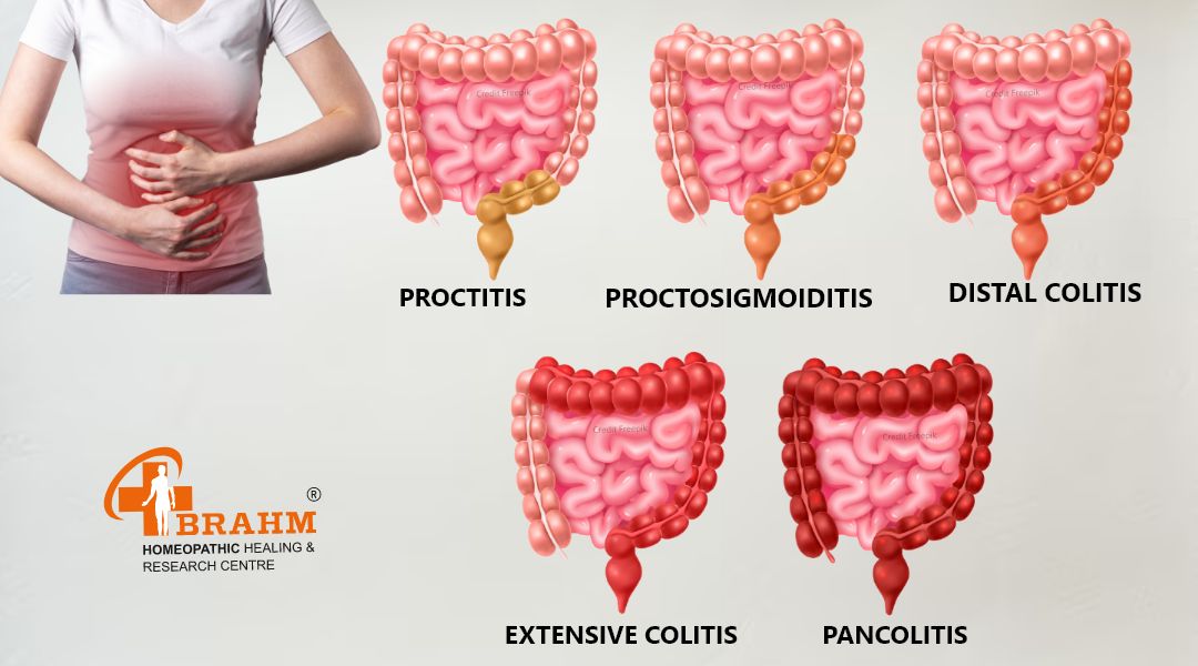 type of ulcerative colitis