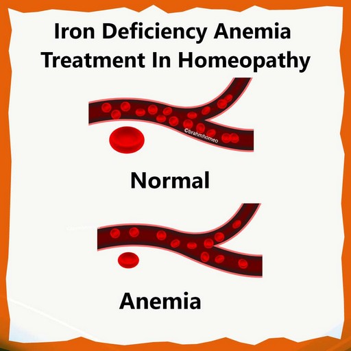 anemia-treatment-in-homeopathy