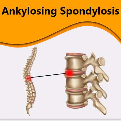 ankylosing-spondylosis