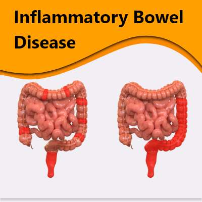 inflammatory-bowel-disease