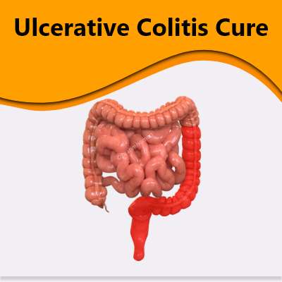 ulcerative-colltis-cure