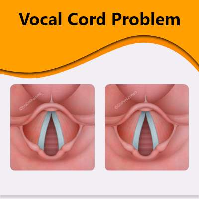 vocal-cord-problem