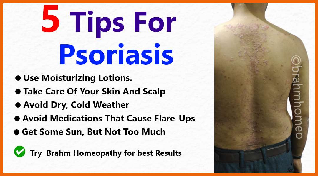 psoriasis treatment