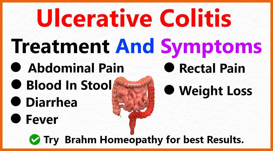 ulcerative colitis