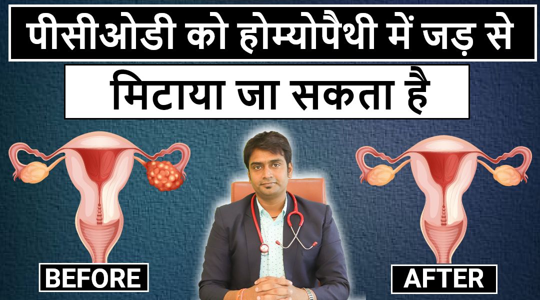 पीसीओडी-को-होम्योपैथी-से-जड़-से-मिटाया-जा-सकता-है